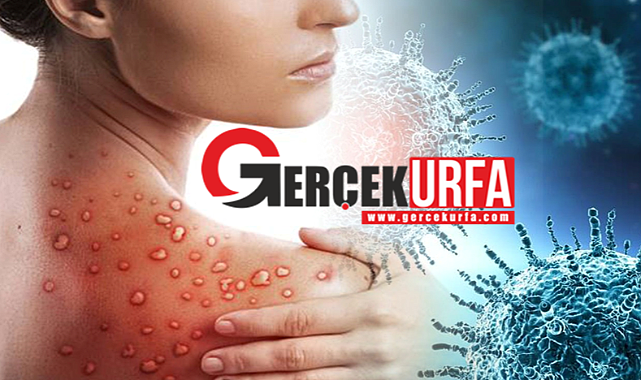 Sağlık Bakanlığı Açıkladı! Maymun Çiçeği Virisünde Merak Edilen Sorular