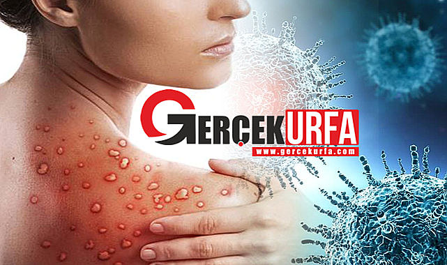 Türkiye'de Maymun Çiçeği Vakası Görüldü İddiasına İlişkin Açıklama